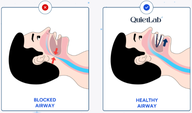 QuietLab Anti-Snoring Mouthguard works
