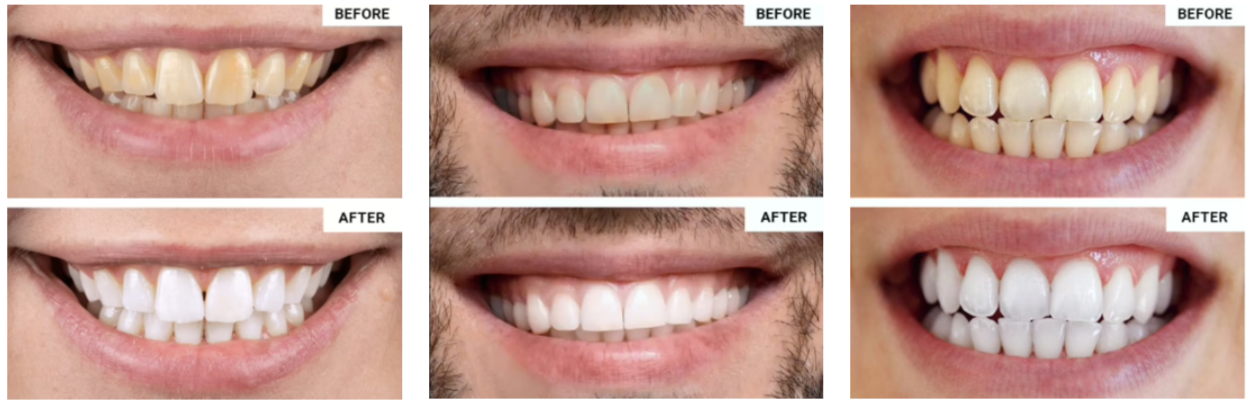 WellaWhite Teeth Whitening Kit work